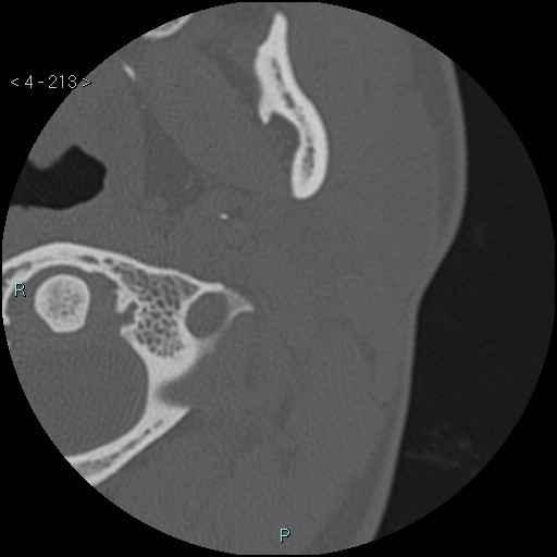 Cholesterol granuloma of the petrous apex (Radiopaedia 64358-73141 Axial bone window 103).jpg