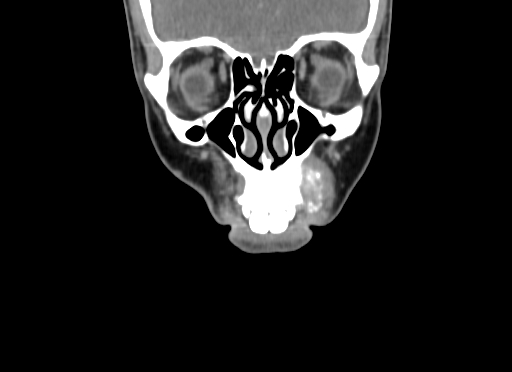 File:Chondroblastic osteosarcoma (Radiopaedia 67363-76741 D 20).jpg