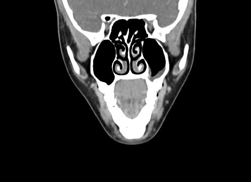 File:Chondroblastic osteosarcoma (Radiopaedia 67363-76741 D 34).jpg