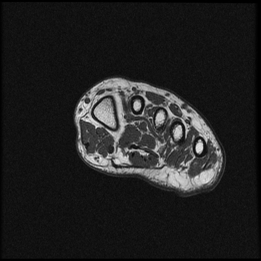 File:Chondroblastoma - midfoot (Radiopaedia 64831-73765 Short axis T1 22).jpg