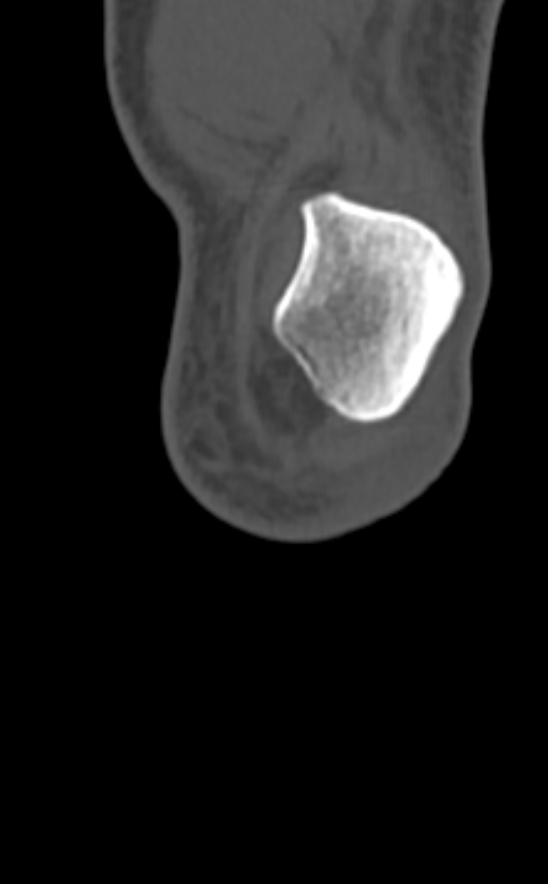 Chondrocalcinosis (Radiopaedia 82862-97173 Coronal bone window 8).jpg