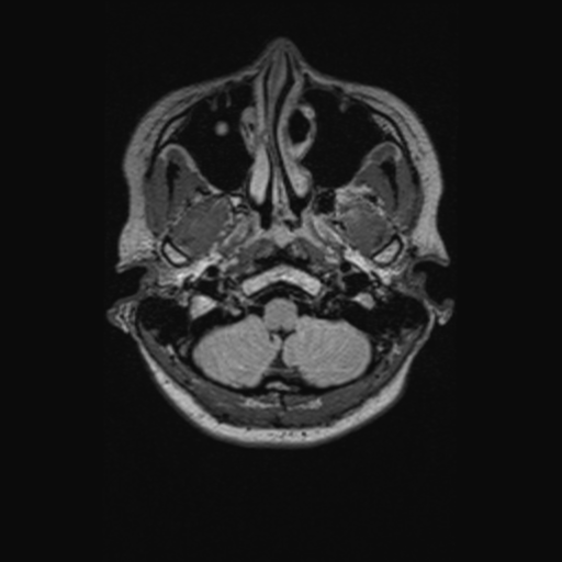 Chondrosarcoma (Radiopaedia 41937-44939 Axial FLAIR 17).png