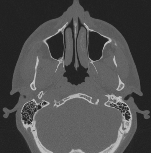 Chondrosarcoma (clivus) (Radiopaedia 46895-51425 Axial bone window 66).png