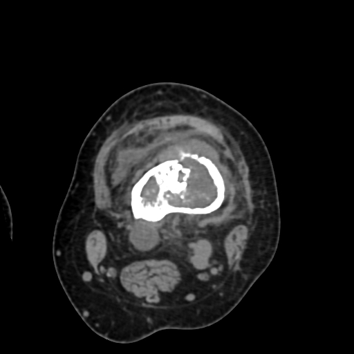 Chondrosarcoma - femur (Radiopaedia 64187-72954 Axial non-contrast 32).jpg