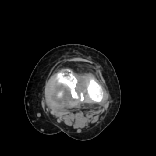 Chondrosarcoma - femur (Radiopaedia 64187-72954 Axial non-contrast 56).jpg