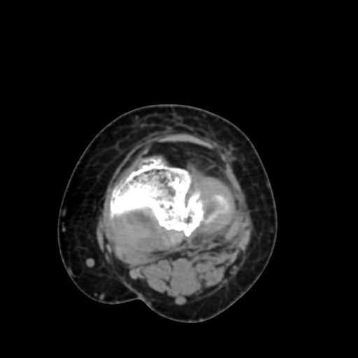Chondrosarcoma - femur (Radiopaedia 64187-72954 Axial non-contrast 58).jpg