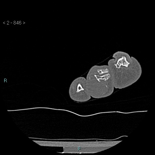 Chondrosarcoma - phalanx (Radiopaedia 69047-78812 Axial bone window 100).jpg