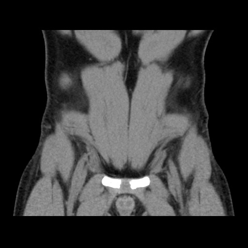 Chondrosarcoma of iliac wing (Radiopaedia 63861-72599 Coronal non-contrast 27).jpg