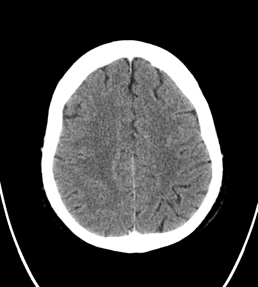 File:Chondrosarcoma of skull base- grade II (Radiopaedia 40948-43653 Axial Contrast 22).png