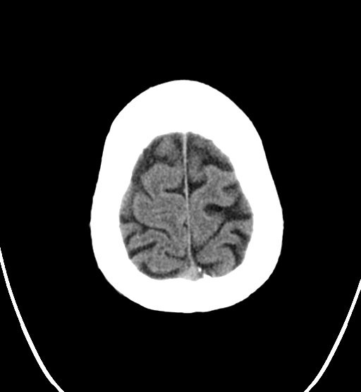 File:Chondrosarcoma of skull base- grade II (Radiopaedia 40948-43653 Axial non-contrast 27).png
