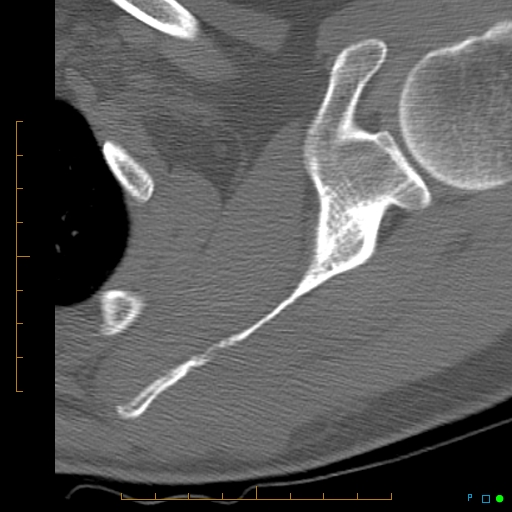 File:Chondrosarcoma of the scapula (Radiopaedia 30696-31399 Axial non-contrast 5).jpg
