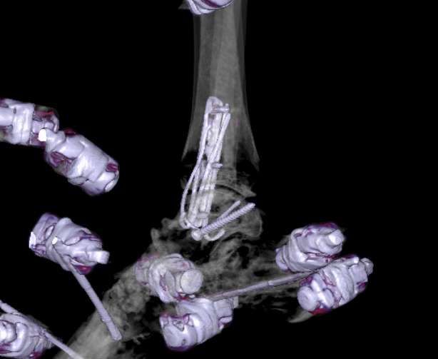 File:Chopart fracture (Radiopaedia 35347-36861 3D MPR bone window 14).jpg