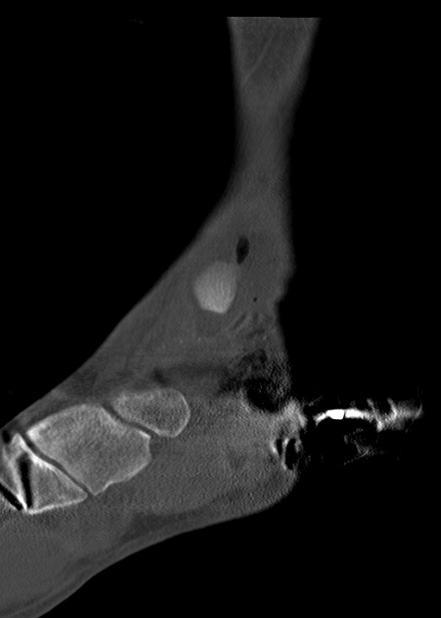 Chopart fracture (Radiopaedia 35347-36861 Sagittal bone window 28).jpg