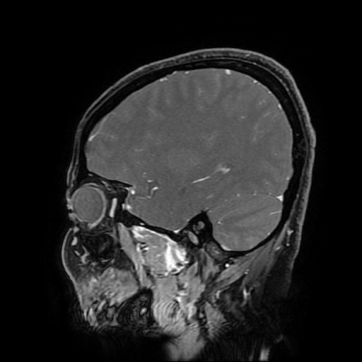 File:Chordoid glioma of third ventricle (Radiopaedia 91612-109340 F 149).jpg