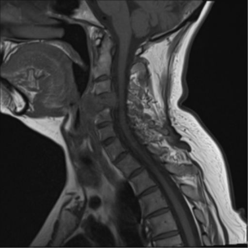 File:Chordoma (C4 vertebra) (Radiopaedia 47561-52189 Sagittal T1 8).png