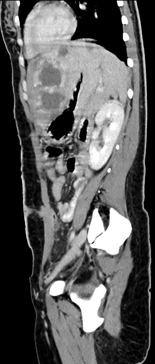 Choriocarcinoma liver metastases (Radiopaedia 74768-85766 C 74).jpg