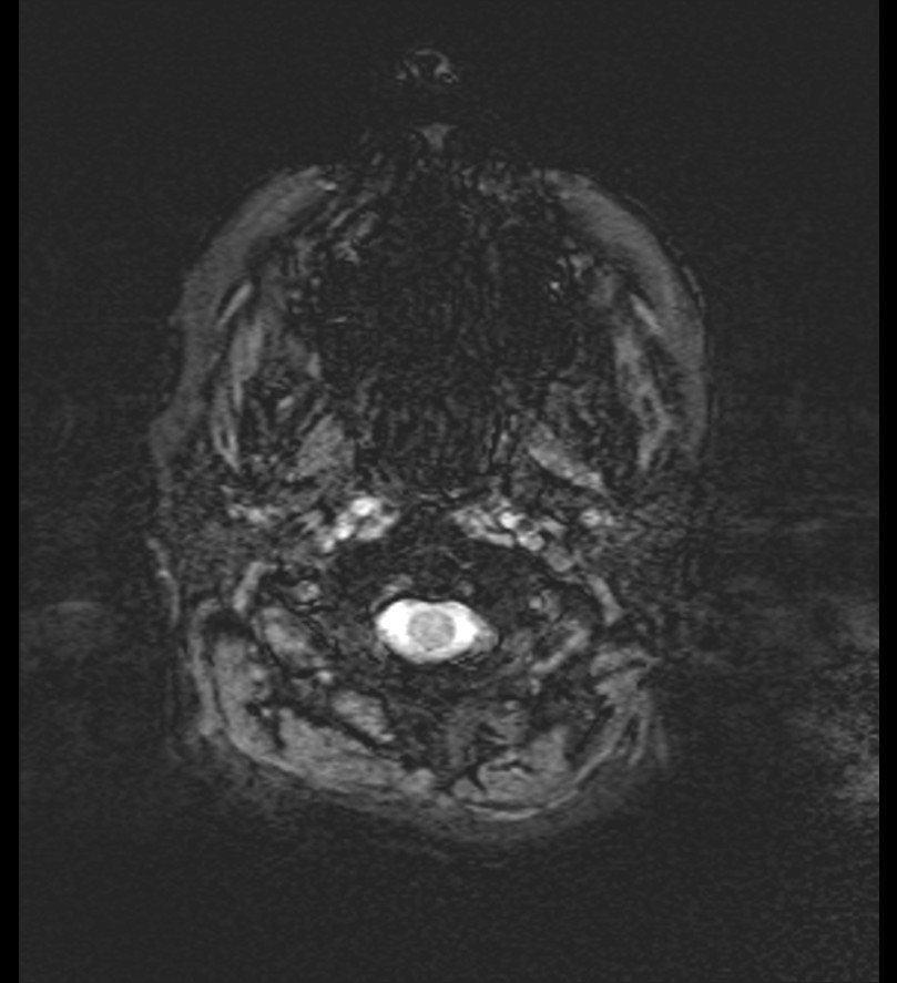 Choroid plexus xanthogranuloma (Radiopaedia 91271-108875 Axial SWI 1).jpg