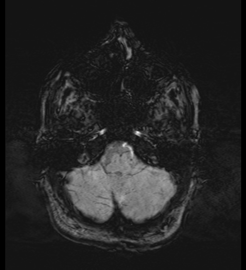 Choroid plexus xanthogranuloma (Radiopaedia 91271-108875 Axial SWI 13).jpg