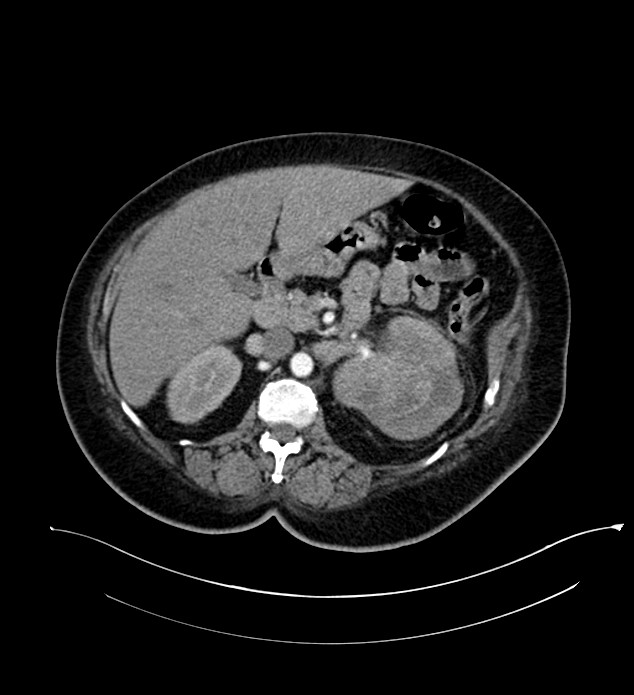 Chromophobe renal cell carcinoma (Radiopaedia 84239-99519 B 44).jpg