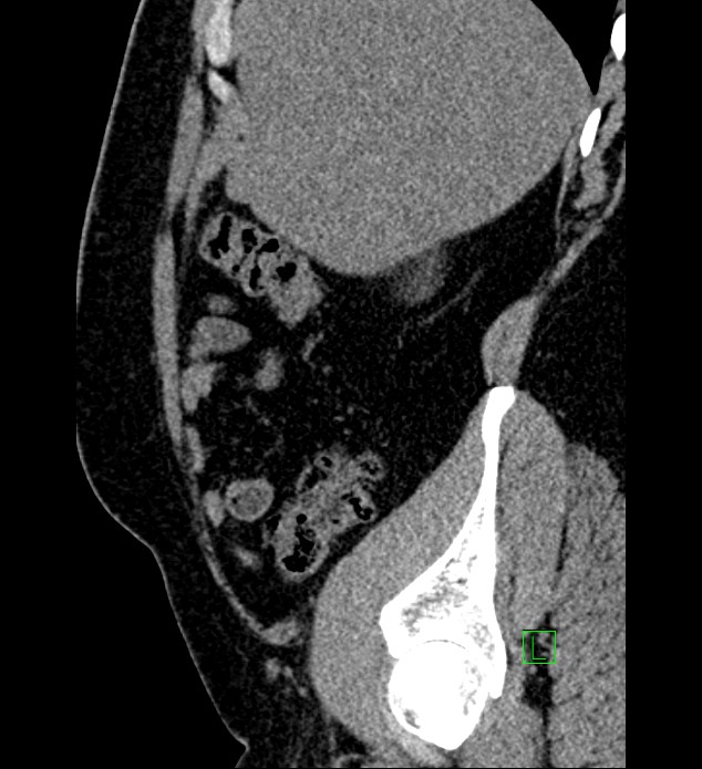 Chromophobe renal cell carcinoma (Radiopaedia 84286-99573 C 147).jpg
