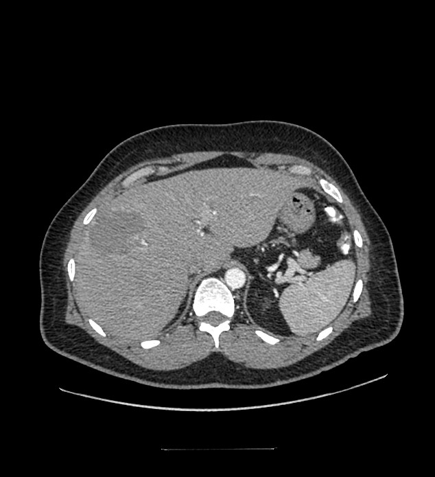 Chromophobe renal cell carcinoma (Radiopaedia 84337-99644 B 18).jpg
