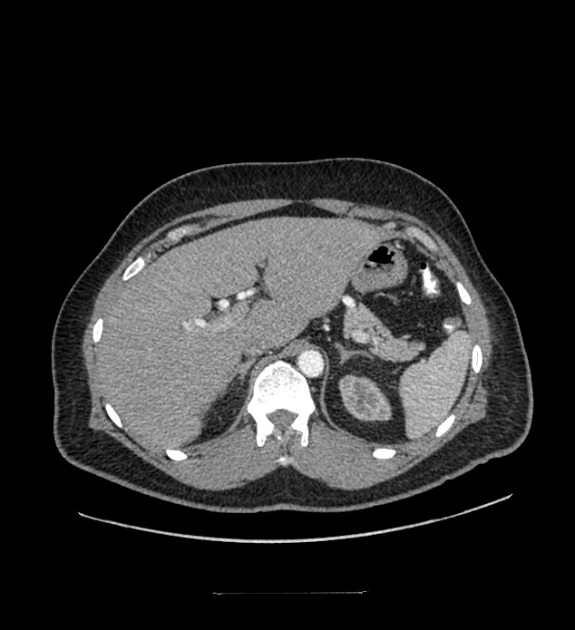 Chromophobe renal cell carcinoma (Radiopaedia 84337-99644 B 23).jpg
