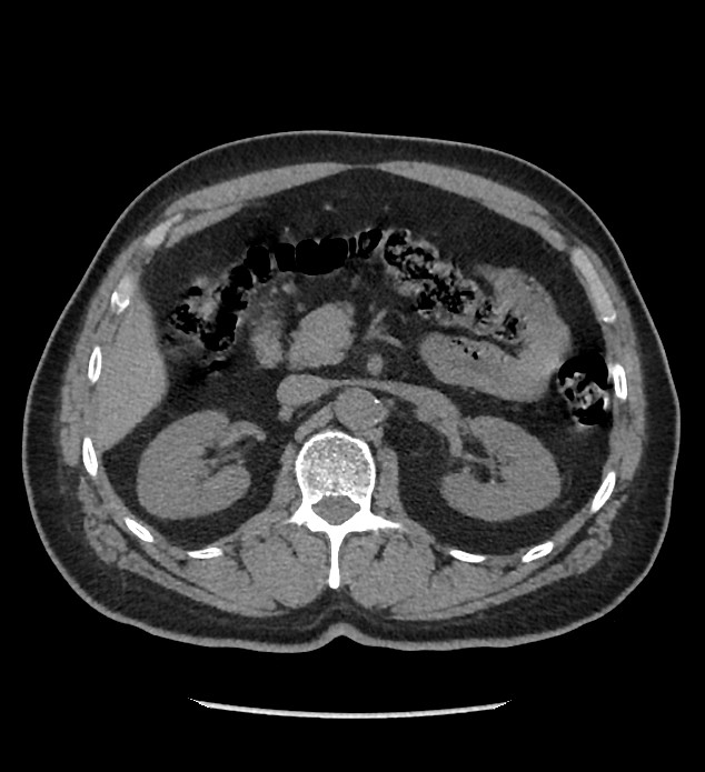 Chromophobe renal cell carcinoma (Radiopaedia 86879-103083 Axial non-contrast 33).jpg