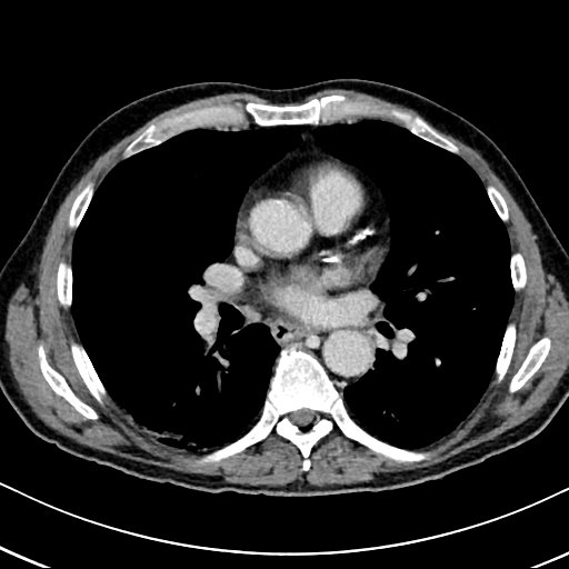 Chronic appendicitis complicated by appendicular abscess, pylephlebitis and liver abscess (Radiopaedia 54483-60700 B 2).jpg