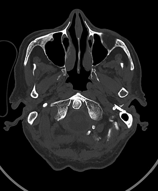 Chronic bilateral subdural hygroma (Radiopaedia 85801-101623 Axial bone window 108).jpg