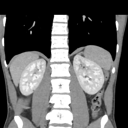 File:Chronic calcific pancreatitis (Radiopaedia 56280-62953 F 24).jpg