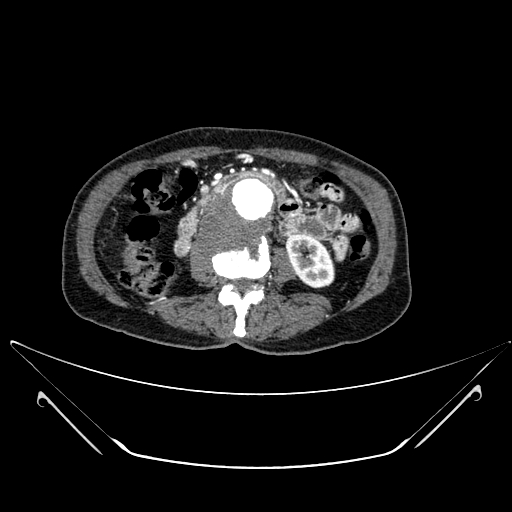Chronic contained rupture of abdominal aortic aneurysm with extensive erosion of the vertebral bodies (Radiopaedia 55450-61901 A 29).jpg