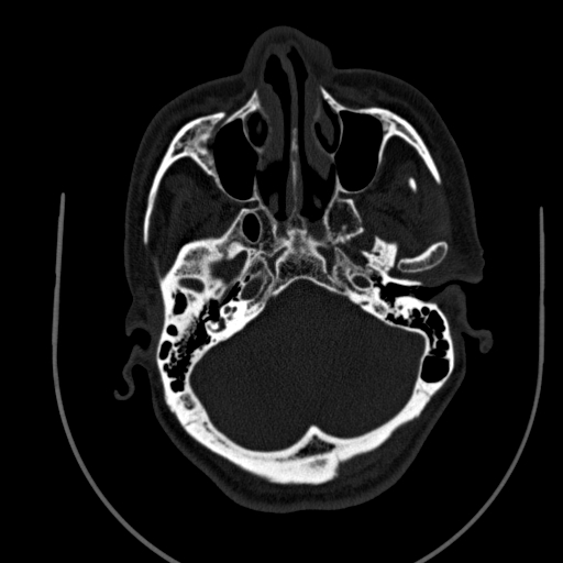 File:Chronic invasive fungal sinusitis (Radiopaedia 91563-109286 Axial sinus 33).jpg