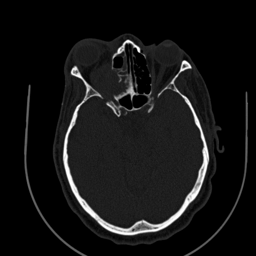 File:Chronic invasive fungal sinusitis (Radiopaedia 91563-109286 Axial sinus 93).jpg