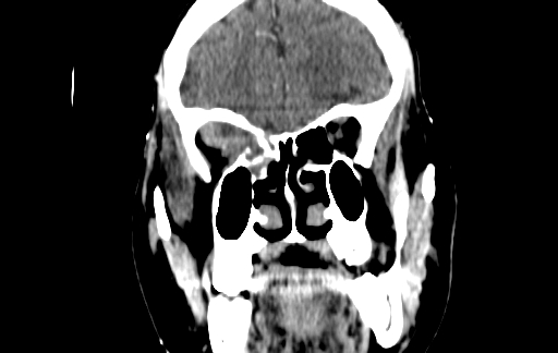 Chronic invasive fungal sinusitis (Radiopaedia 91563-109286 D 47).jpg