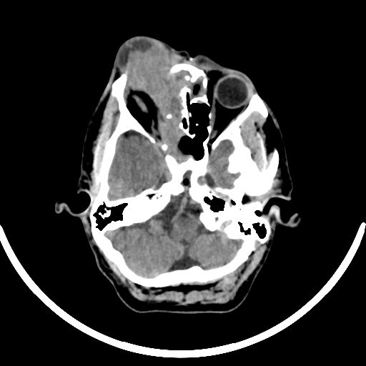 Chronic invasive fungal sinusitis with intraorbital and intracranial extension (Radiopaedia 56387-63046 Axial non-contrast 122).jpg