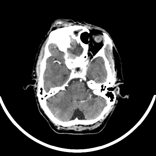 Chronic invasive fungal sinusitis with intraorbital and intracranial extension (Radiopaedia 56387-63046 B 114).jpg