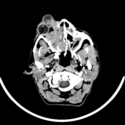 Chronic invasive fungal sinusitis with intraorbital and intracranial extension (Radiopaedia 56387-63046 B 53).jpg
