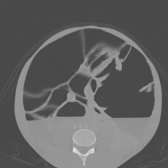 Chronic large bowel pseudo-obstruction (Radiopaedia 43181-46492 Axial bone window 113).jpg