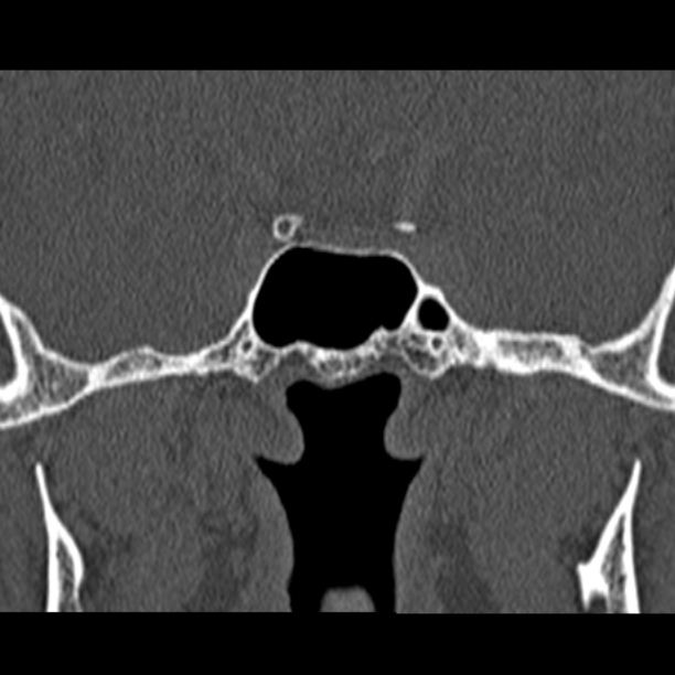 Chronic maxillary sinusitis (Radiopaedia 27879-28116 Coronal bone window 50).jpg