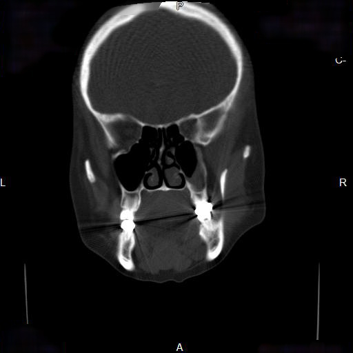 File:Chronic maxillary sinusitis with a foreign body (dental filling material) (Radiopaedia 7811-8639 Coronal bone window 8).jpg