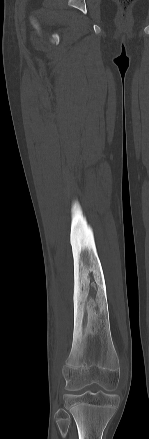 Chronic ostemyelitis of the femur with long sinus tract (Radiopaedia 74947-85982 Coronal bone window 46).jpg