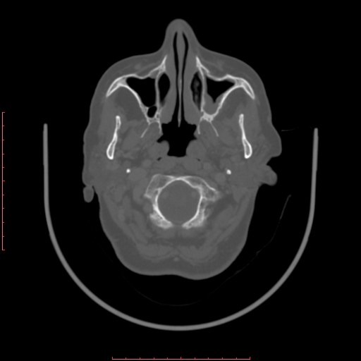 File:Chronic osteomyelitis - maxilla (Radiopaedia 23783-23927 Axial bone window 104).jpg