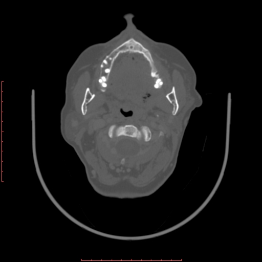 Chronic osteomyelitis - maxilla (Radiopaedia 23783-23927 Axial bone window 74).jpg