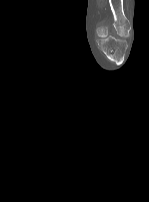 Chronic osteomyelitis - tibia (with sequestrum) (Radiopaedia 73273-84090 Coronal non-contrast 7).jpg