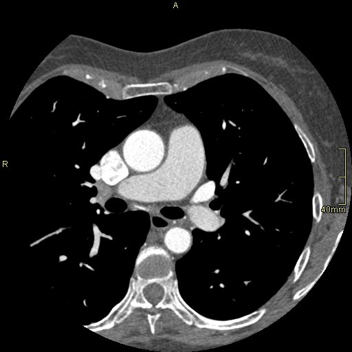 Chronic pulmonary embolism (Radiopaedia 73073-85094 Axial C+ CTPA 62).jpg