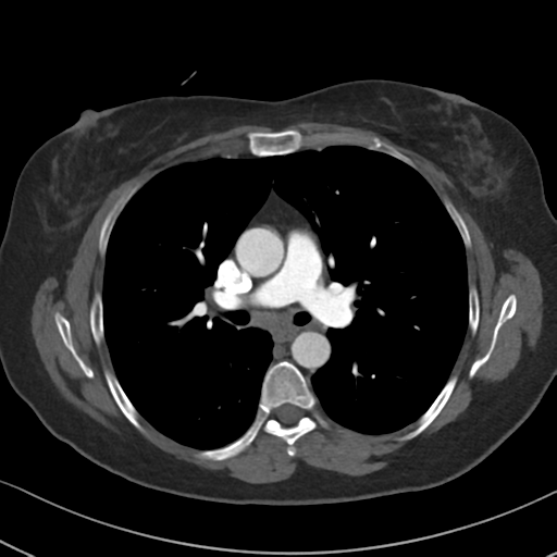 Chronic pulmonary embolus (Radiopaedia 39129-41341 Axial C+ CTPA 46).png