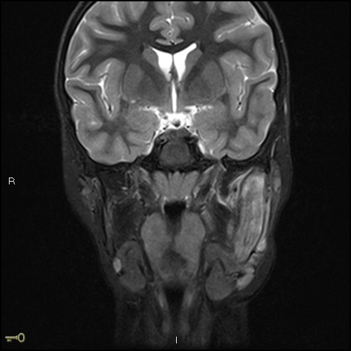 File:Chronic reactive multifocal osteomyelitis (CRMO) - mandible (Radiopaedia 56405-63069 Coronal STIR 19).jpg