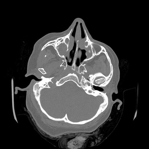 Chronic sinusitis with intra-sinus calcification (Radiopaedia 63919-72668 Axial bone window 47).jpg