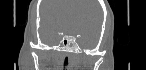 Chronic sphenoidal sinusitis (Radiopaedia 62030-70122 Coronal bone window 130).jpg