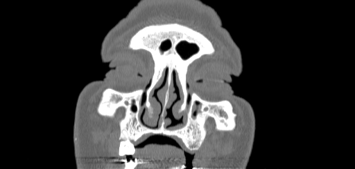 Chronic sphenoidal sinusitis (Radiopaedia 62030-70122 Coronal bone window 19).jpg